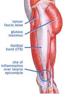 Iliotibial band syndrome